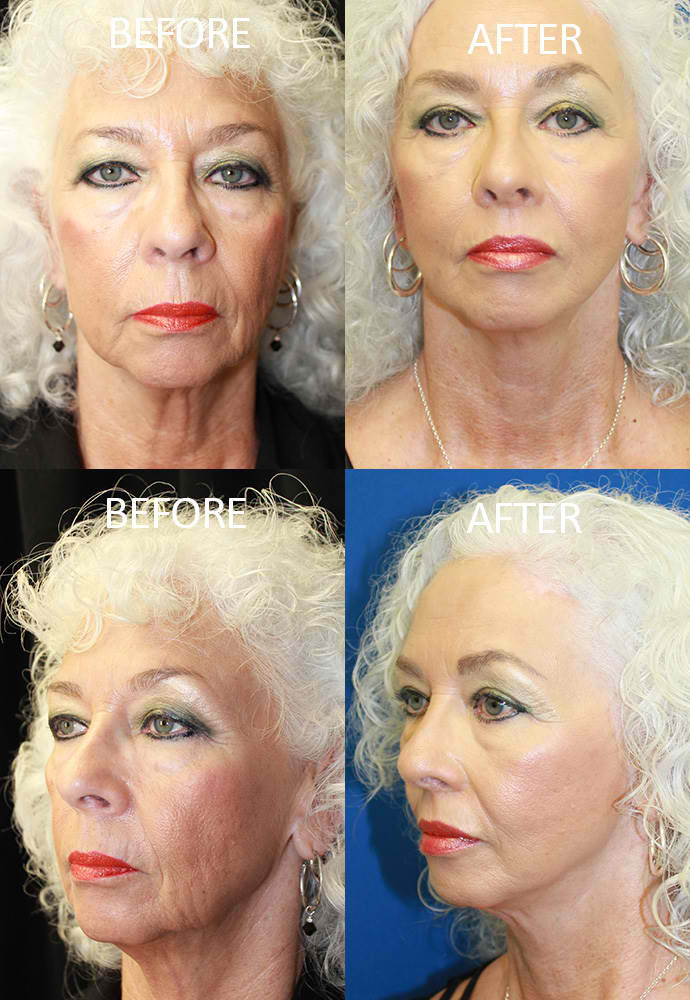 Face & Neck Lift