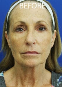 Mardirossian Facial Aesthetics Before and After Pictures