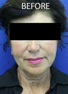 Mardirossian Facial Aesthetics Before and After Pictures