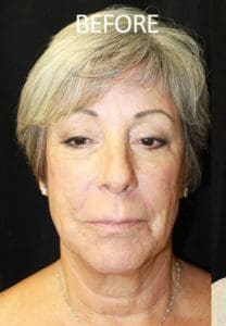 Mardirossian Facial Aesthetics Before and After Pictures