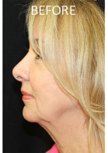 Mardirossian Facial Aesthetics Before and After Pictures