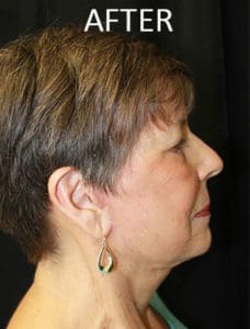 Facelift and Neck lift Before and After Pictures West Palm Beach, FL