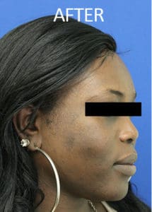 Mandible Contouring Before and After Pictures West Palm Beach, FL
