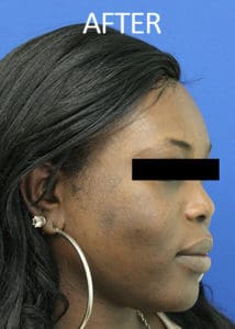 Facial Feminization Surgery (FFS) Before and After Pictures West Palm Beach, FL