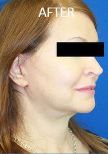 Mardirossian Facial Aesthetics Before and After Pictures