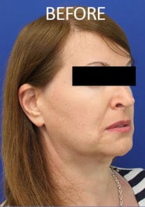 Mardirossian Facial Aesthetics Before and After Pictures