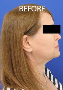 Mardirossian Facial Aesthetics Before and After Pictures