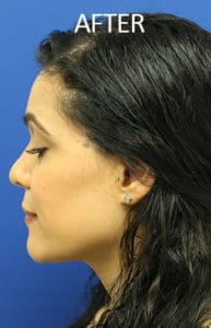 Facial Feminization Surgery (FFS) Before and After Pictures West Palm Beach, FL