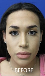Facial Feminization Surgery (FFS) Before and After Pictures West Palm Beach, FL