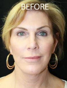 Scalp Advancement Before and After Pictures West Palm Beach, FL