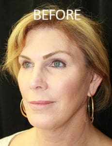 Scalp Advancement Before and After Pictures West Palm Beach, FL