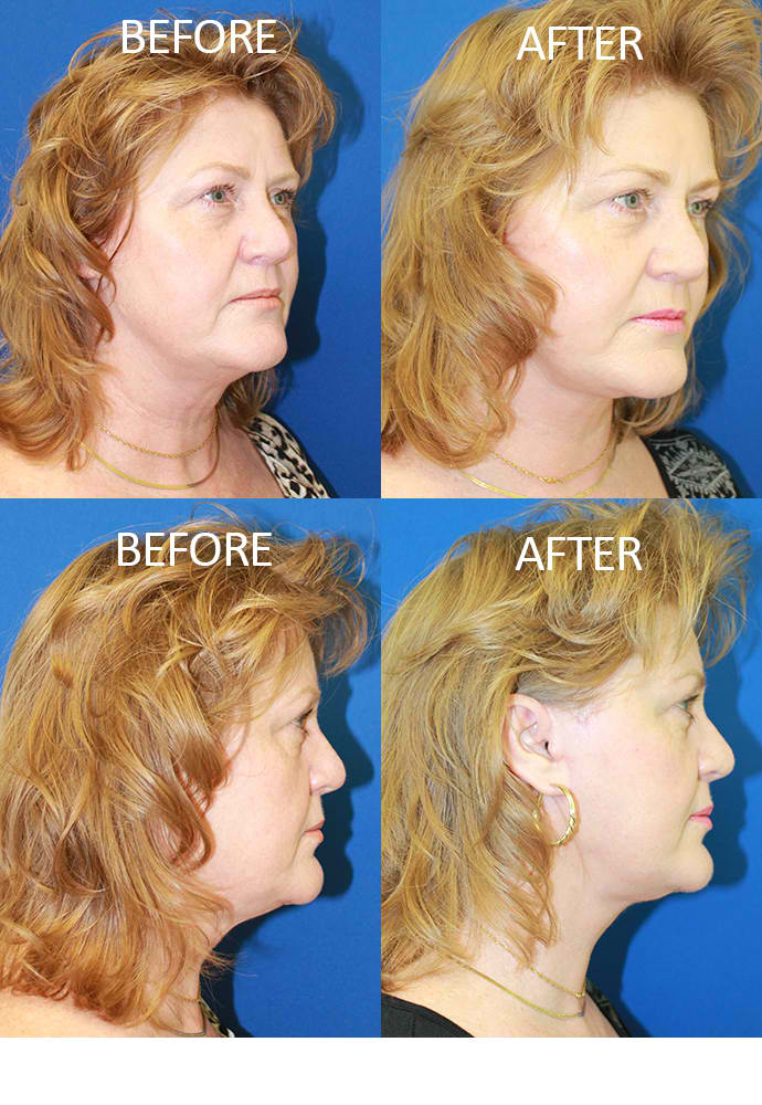 Face & Neck Lift