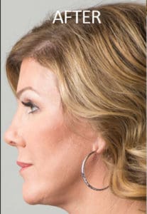 Rhinoplasty Before and After Pictures West Palm Beach, FL