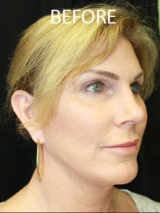 Mandible Contouring Before and After Pictures West Palm Beach, FL
