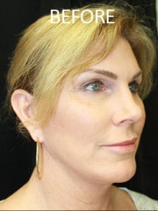 Mardirossian Facial Aesthetics Before and After Pictures