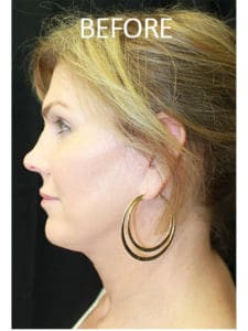 Mandible Contouring Before and After Pictures West Palm Beach, FL