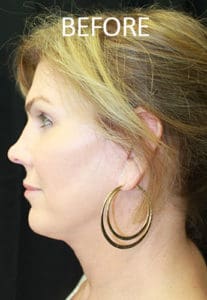 Rhinoplasty Before and After Pictures West Palm Beach, FL