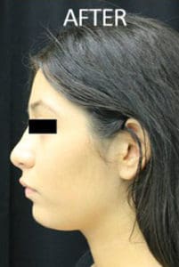 Forehead Contouring Before and After Pictures West Palm Beach, FL