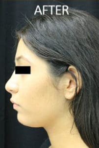 Scalp Advancement Before and After Pictures West Palm Beach, FL