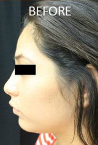 Scalp Advancement Before and After Pictures West Palm Beach, FL