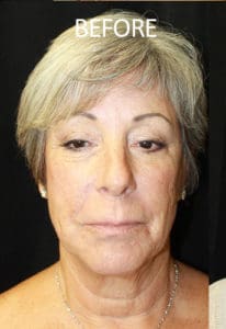 Mardirossian Facial Aesthetics Before and After Pictures