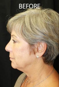 Lip Lift Before and After Pictures West Palm Beach, FL