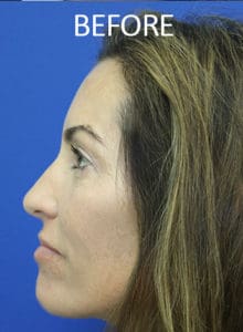 Lip Implants Before and After Pictures West Palm Beach, FL