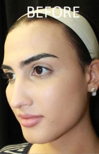 Mandible Contouring Before and After Pictures West Palm Beach, FL