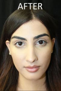 Mardirossian Facial Aesthetics Before and After Pictures