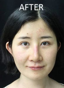 Rhinoplasty Before and After Pictures West Palm Beach, FL