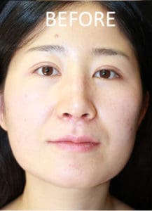 Rhinoplasty Before and After Pictures West Palm Beach, FL