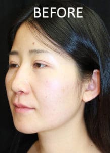 Rhinoplasty Before and After Pictures West Palm Beach, FL