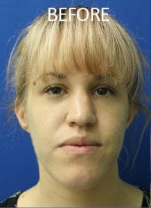 Mandible Contouring Before and After Pictures West Palm Beach, FL