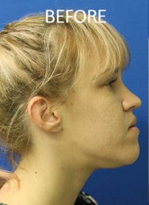 Mandible Contouring Before and After Pictures West Palm Beach, FL