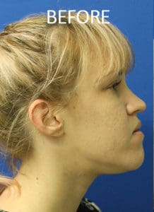 Mardirossian Facial Aesthetics Before and After Pictures