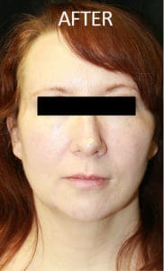 Mandible Contouring Before and After Pictures West Palm Beach, FL