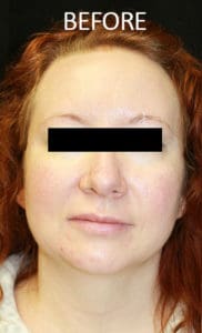Mandible Contouring Before and After Pictures West Palm Beach, FL