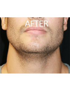 Mandible Implants Before and After Pictures West Palm Beach, FL