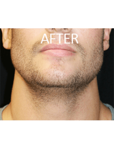 Mardirossian Facial Aesthetics Before and After Pictures