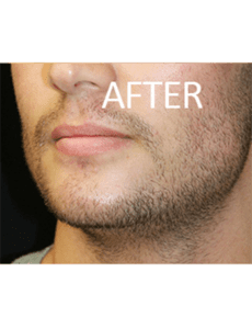 Mandible Implants Before and After Pictures West Palm Beach, FL