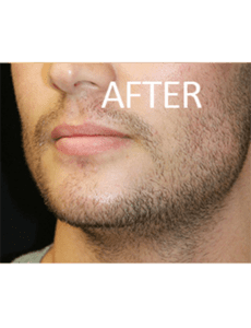 Mandible Implants Before and After Pictures West Palm Beach, FL