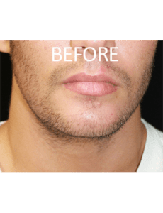 Mandible Implants Before and After Pictures West Palm Beach, FL