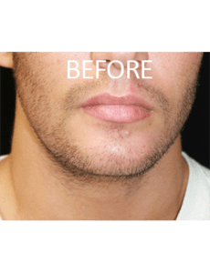 Mardirossian Facial Aesthetics Before and After Pictures