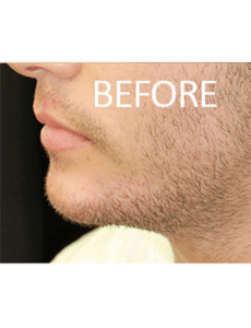 Mandible Implants Before and After Pictures West Palm Beach, FL