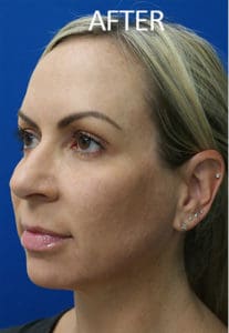 Mandible Implants Before and After Pictures West Palm Beach, FL
