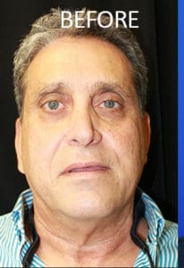 Midface Lift Before and After Pictures West Palm Beach, FL