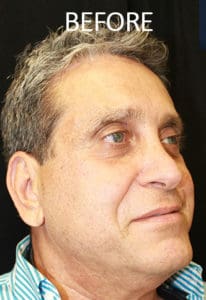 Midface Lift Before and After Pictures West Palm Beach, FL