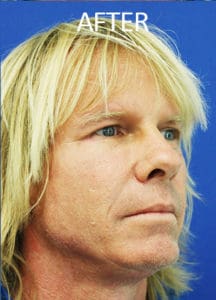 Midface Lift Before and After Pictures West Palm Beach, FL