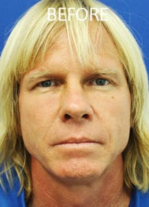 Midface Lift Before and After Pictures West Palm Beach, FL