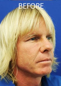 Midface Lift Before and After Pictures West Palm Beach, FL